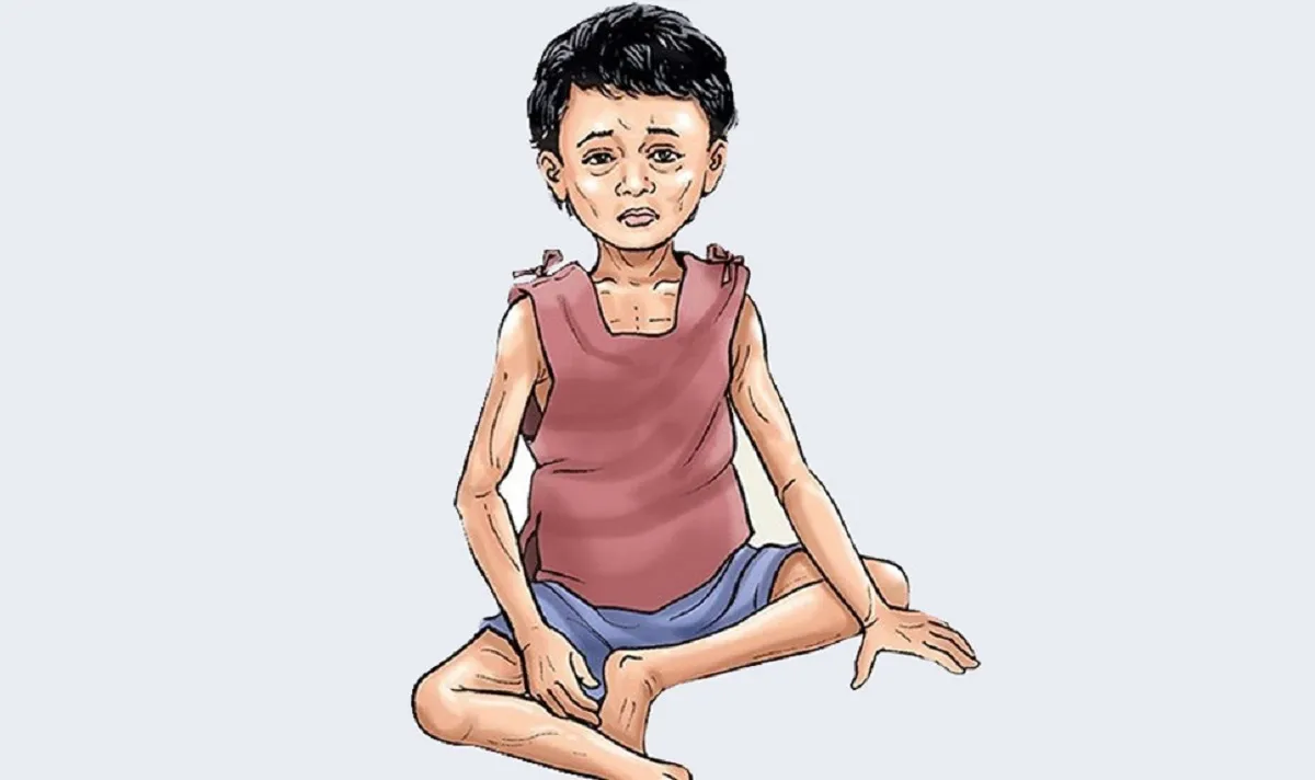 मधेस प्रदेशमा १६ प्रतिशत बालबालिकामा कुपोषण